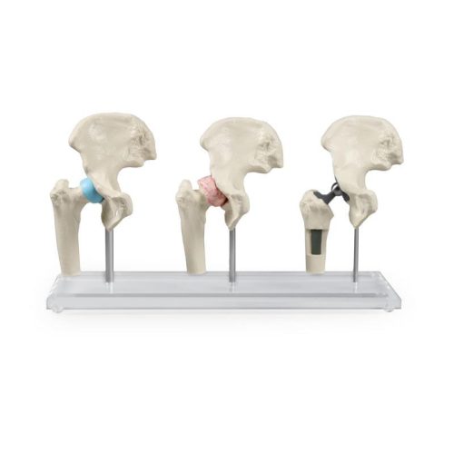 Csípő implantátum modell