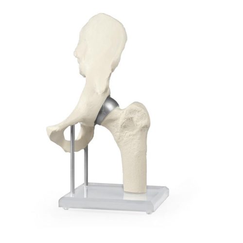 Csípőízület felszíni implantátummal