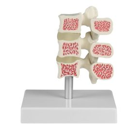 Osteoporosis csigolya modell, 3 csigolya