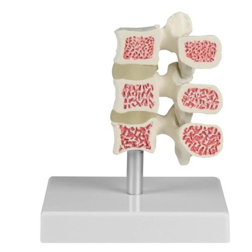 Osteoporosis csigolya modell, 3 csigolya