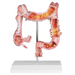 A vastagbél modellje betegségekkel