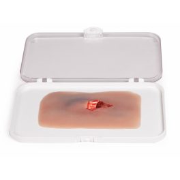 Sebmoulage nyitott törés