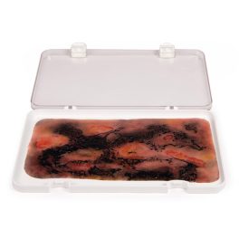 Sebmoulage 3. fokú égési sérülés