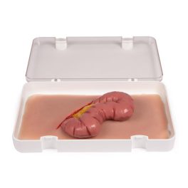 A vastagbél sebmoulage kiemelkedése