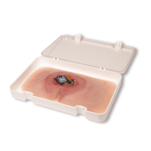 Sebmoulage sacral decubitus, kezeletlen