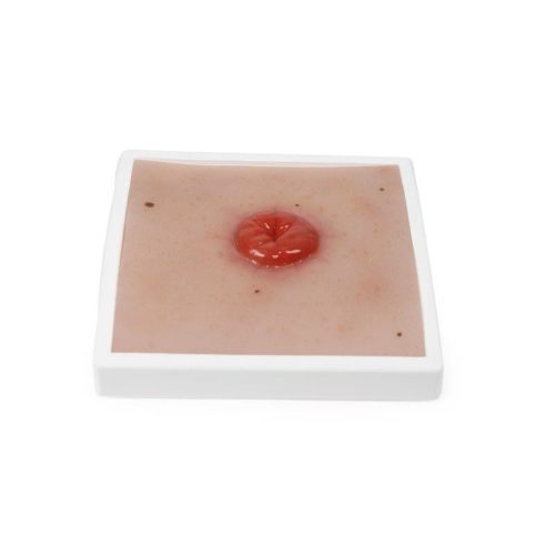 Colostoma sebfelszín, állvánnyal